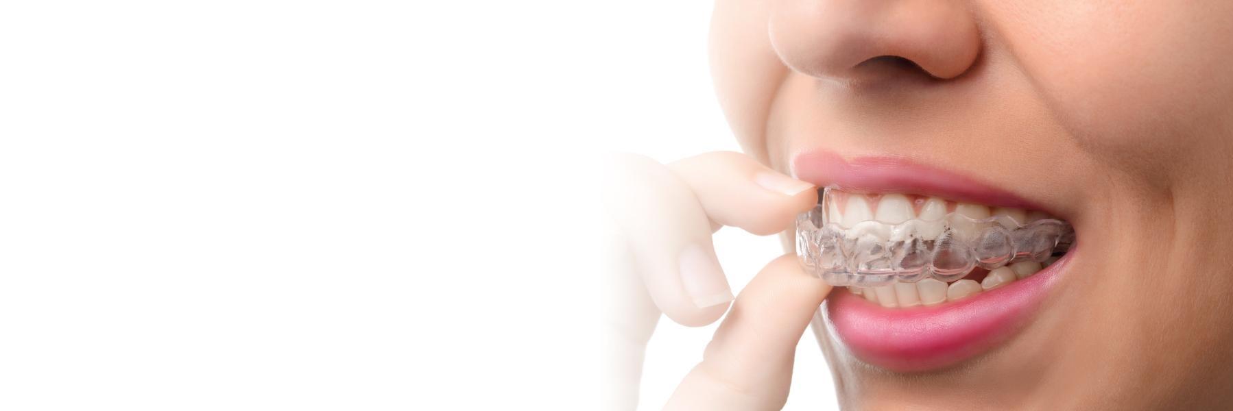 Woman putting in Invisalign clear aligner l Orthodontics Temple TX
