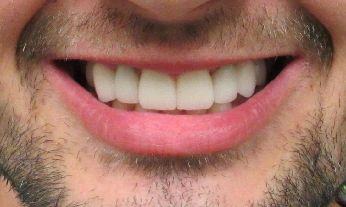 image of the same teeth after dental implants | temple tx