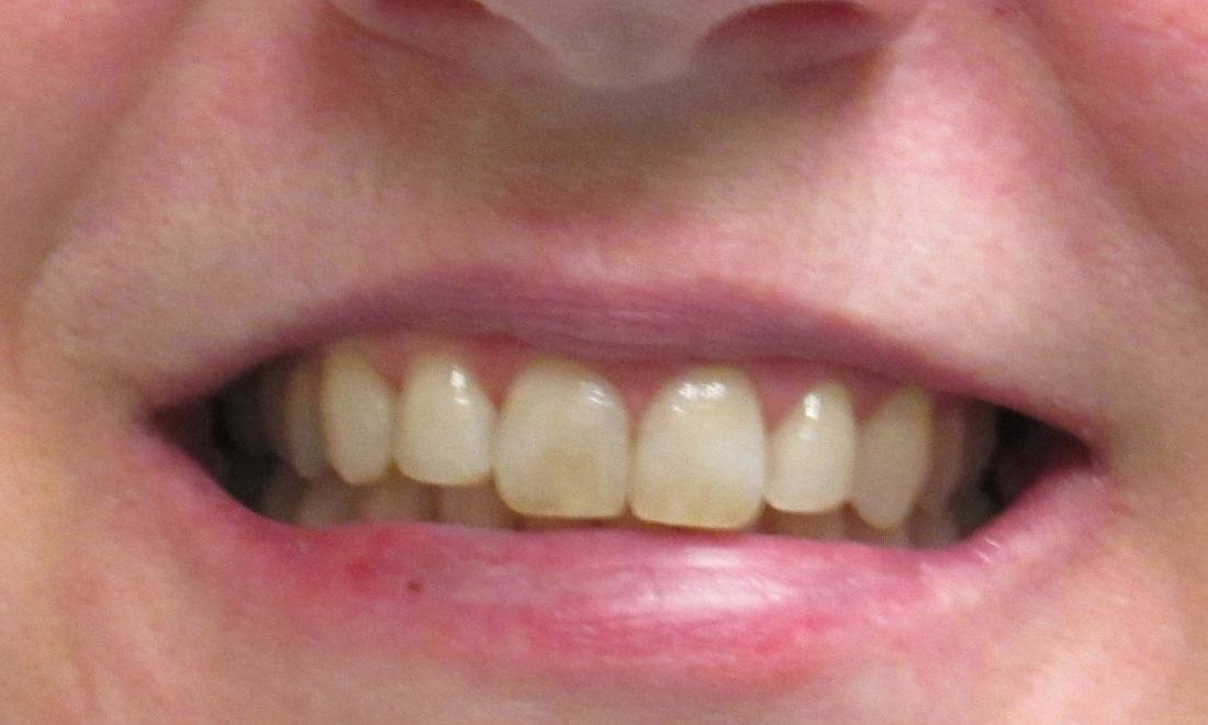 image of the same teeth after invisalign clear aligners | temple tx