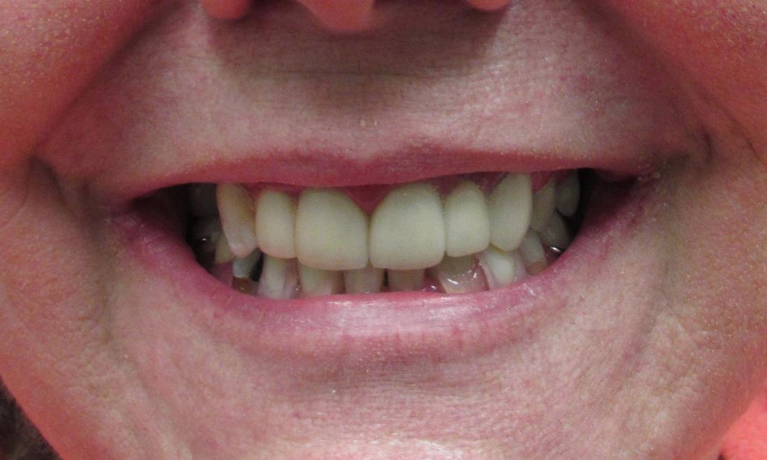 image of the same teeth after crowns and bridges | temple tx