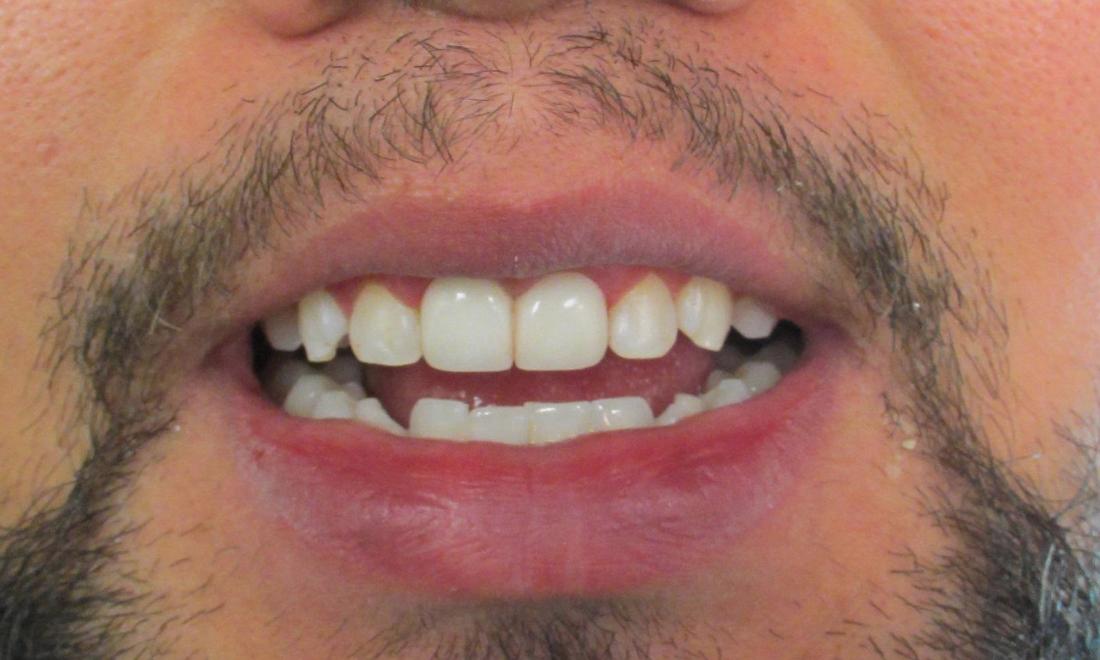 after image of the same teeth after crowns and Zoom whitening | temple tx