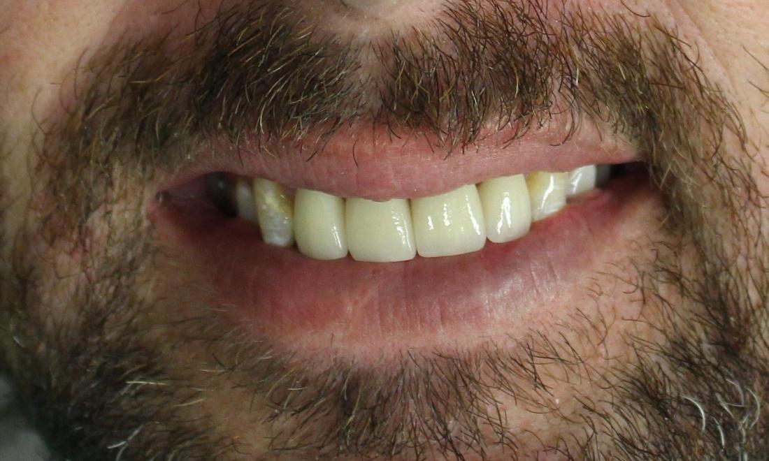 image of the same teeth after cavity repair, porcelain crowns, and a straighter smile | temple tx
