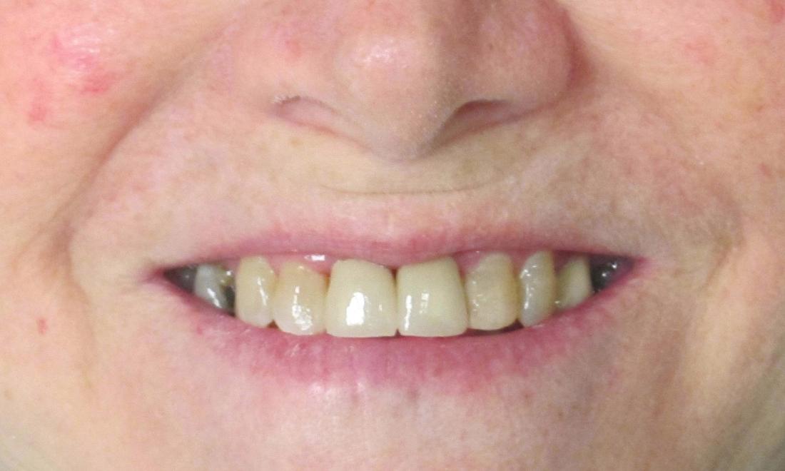 image of the same teeth after crowns | temple tx