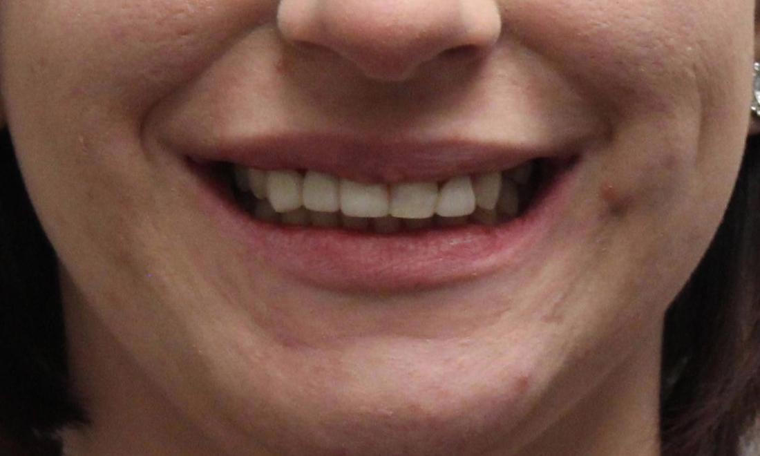image of the same patient after orthodontics, bridge, and implant | temple tx