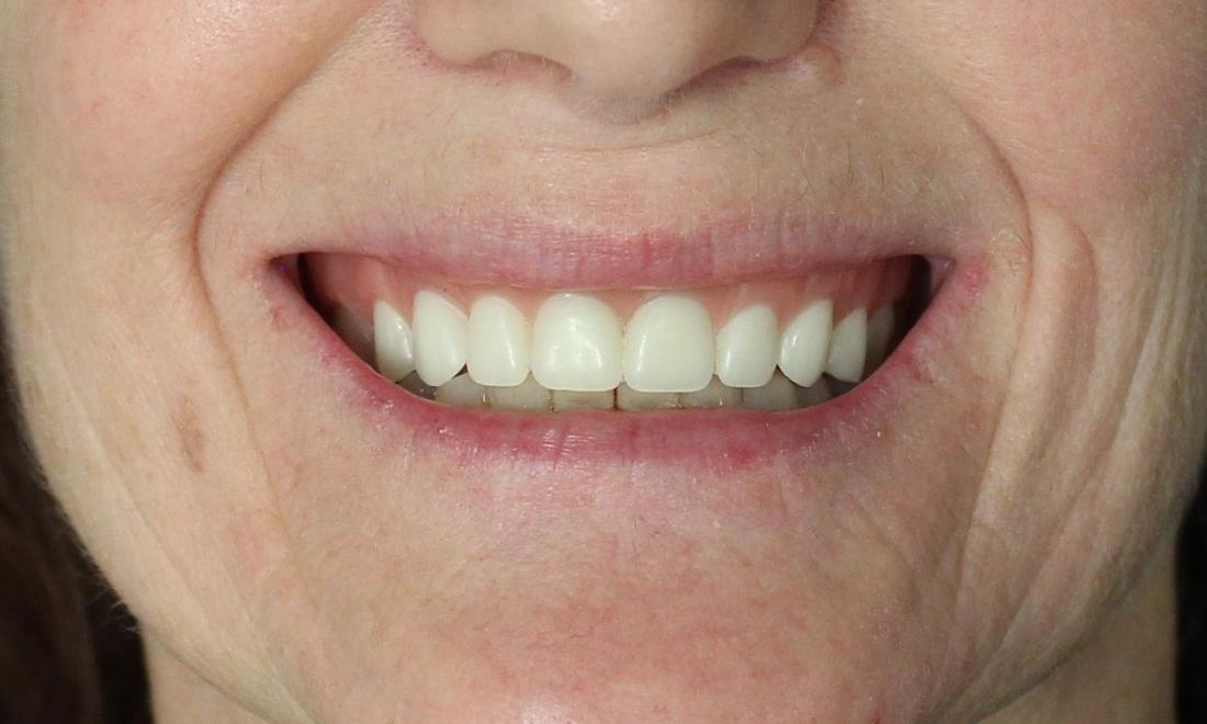 image of new dentures for a better smile | temple tx