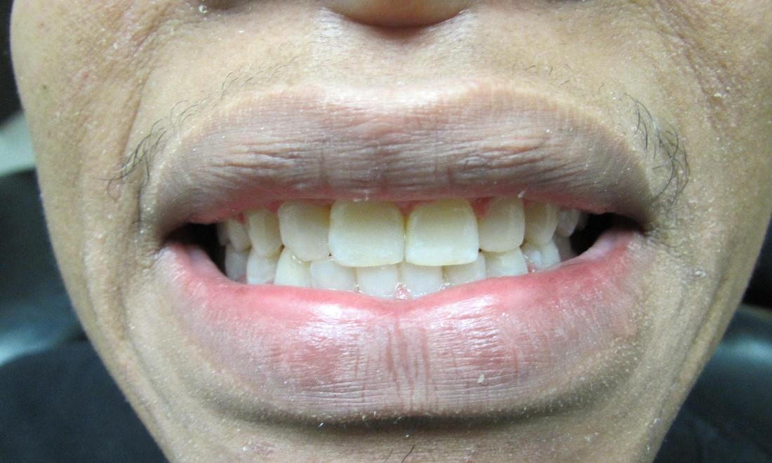 Dentist Temple TX Before and After Spacing In Front Teeth