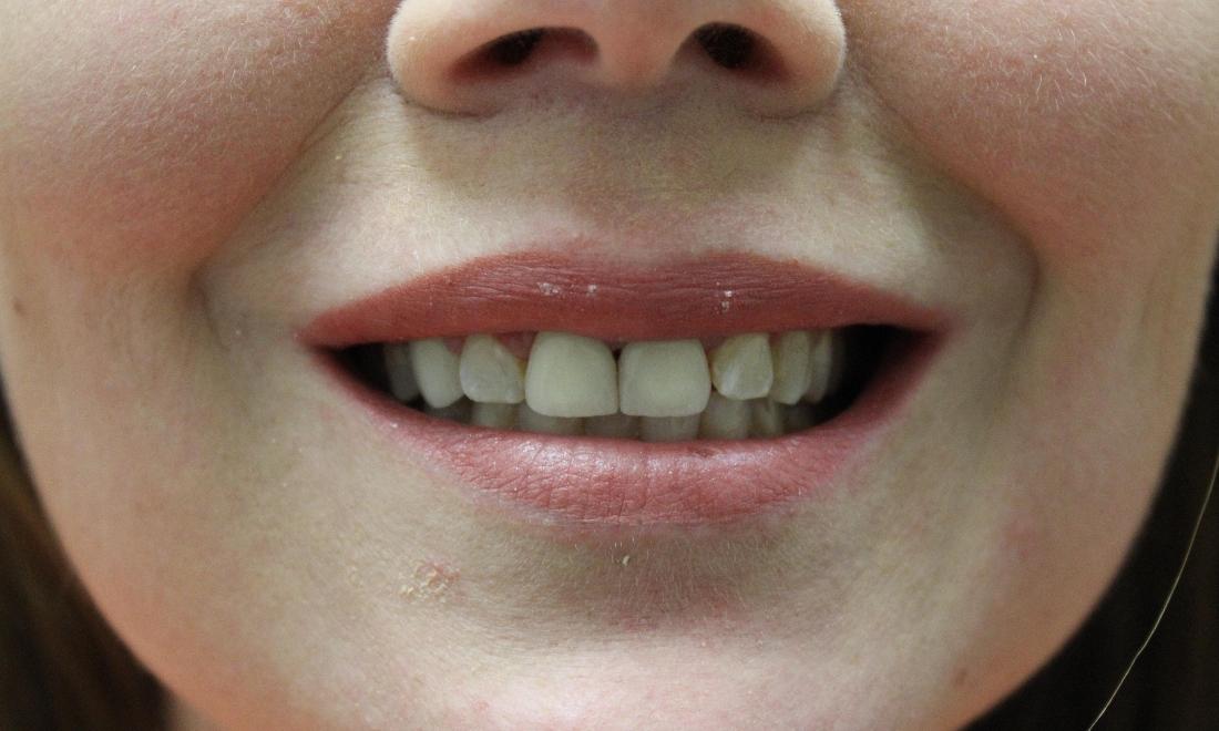 image of the same teeth after porcelain crowns | temple tx