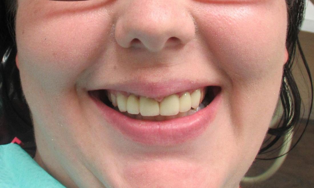 image of the same teeth after porcelain crowns | temple tx