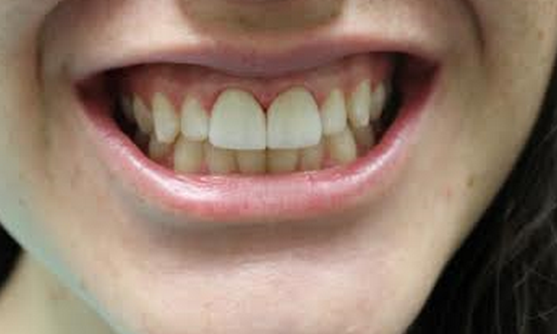 image of the same teeth after dental veneers | temple tx
