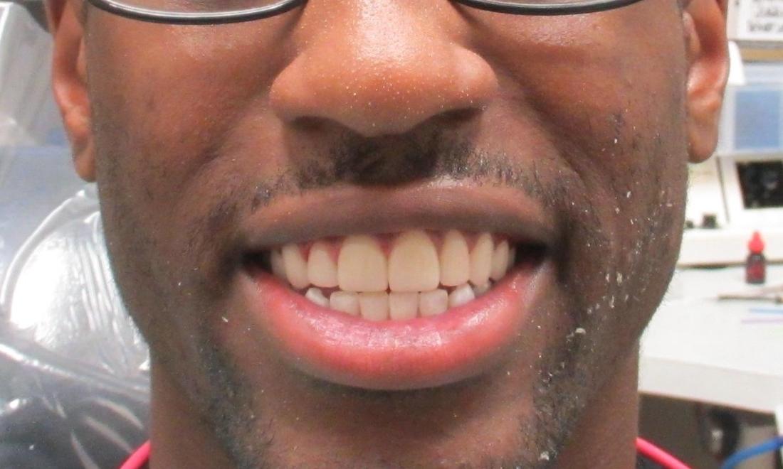 image of the same teeth after dental veneers | temple tx