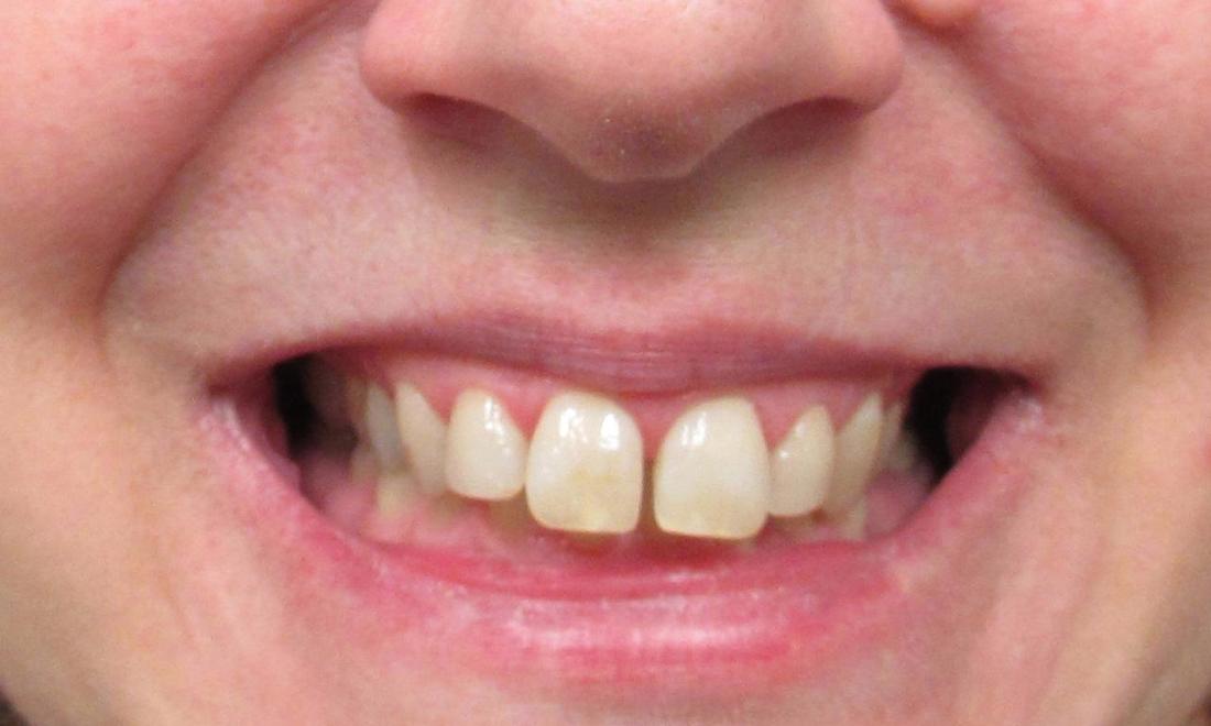 image of teeth before invisalign clear aligners | temple tx