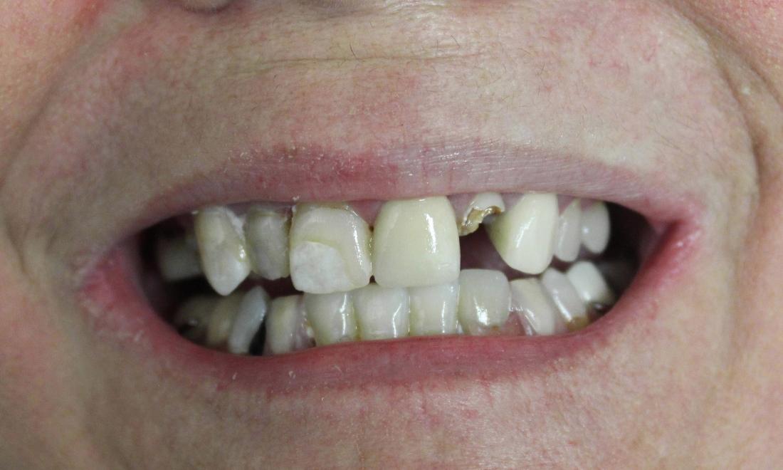 image of teeth before crowns and bridges | temple tx
