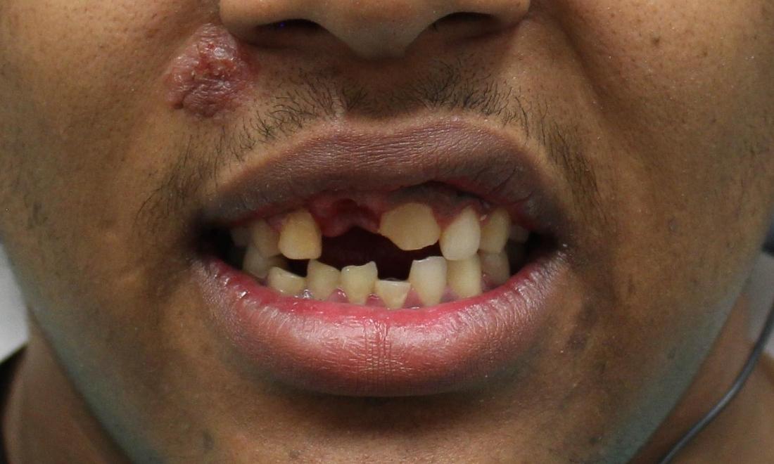 image of chipped and missing teeth following an accident | temple tx