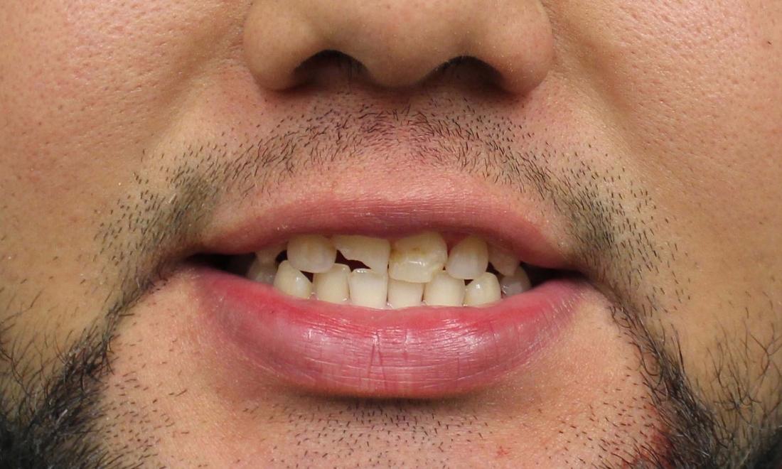 before image of discolored and chipped teeth | temple tx