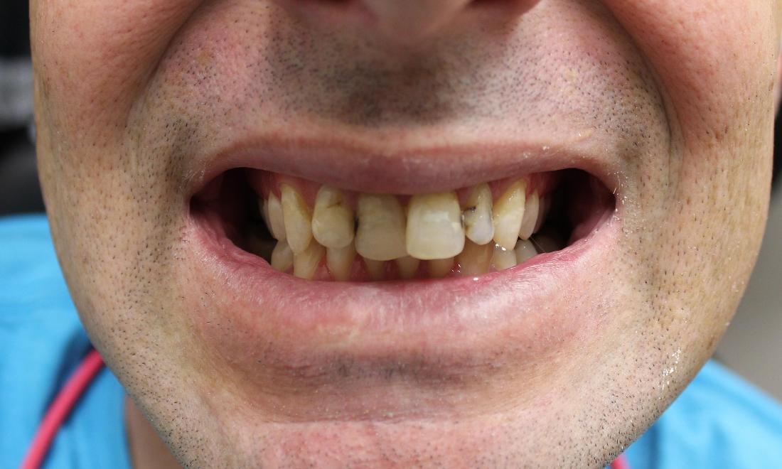 image of teeth with cavities and undesirable shape | temple tx