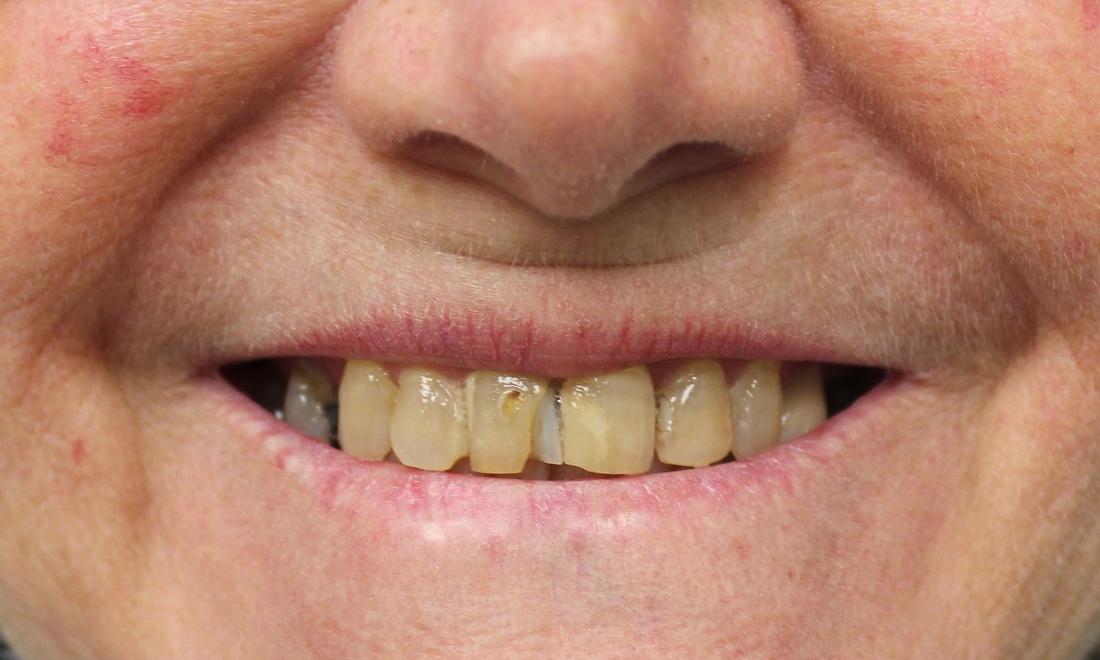image of chipped teeth before crowns | temple tx
