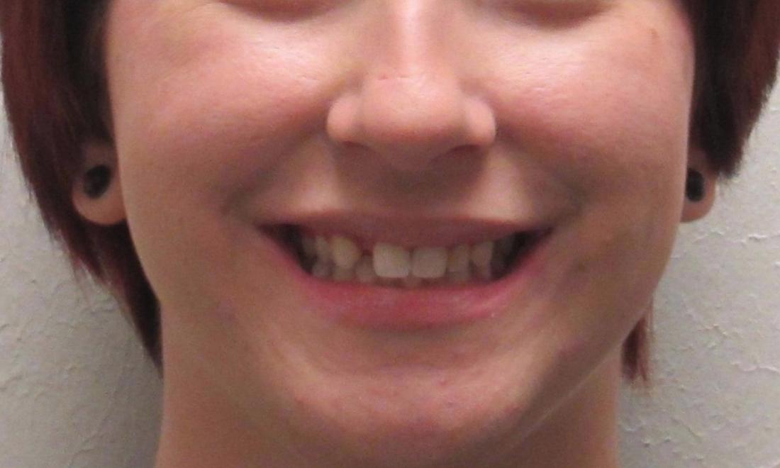 image of a missing tooth | temple tx