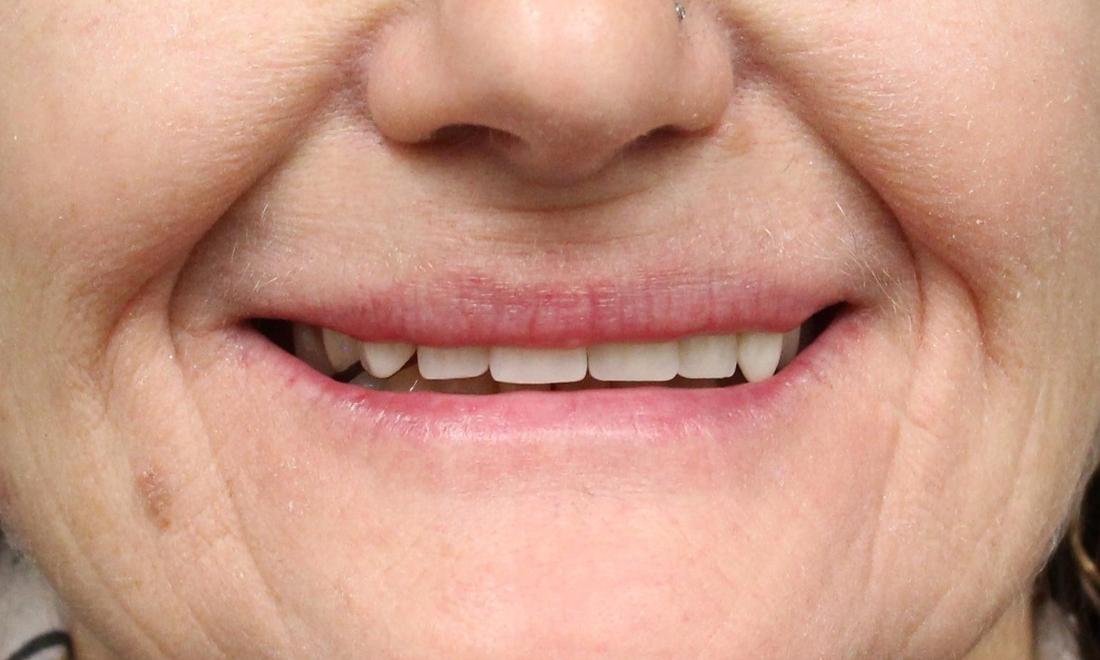 image of a patients old dentures | temple tx