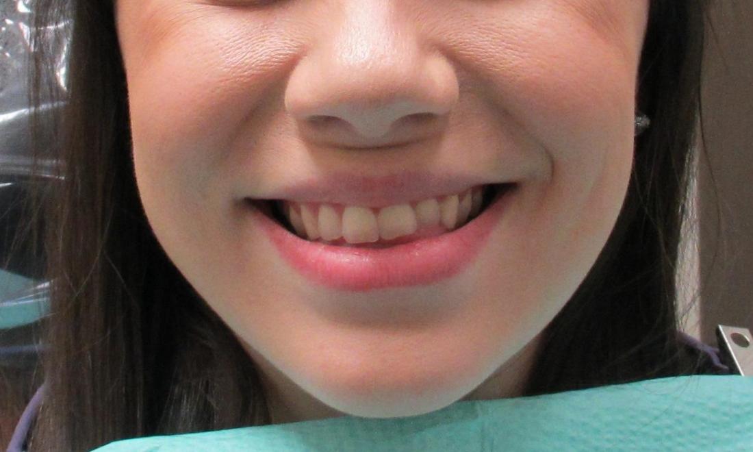image of teeth before orthodontic treatment | temple tx