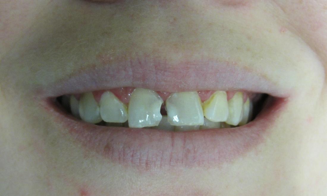 image of teeth before porcelain crowns | temple tx