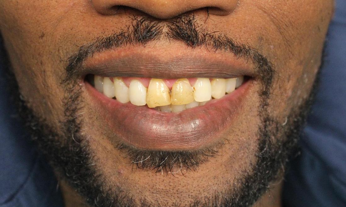 image of discolored teeth following a root canal treatment | temple tx