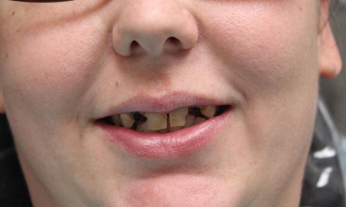 image of missing teeth and cavities | temple tx