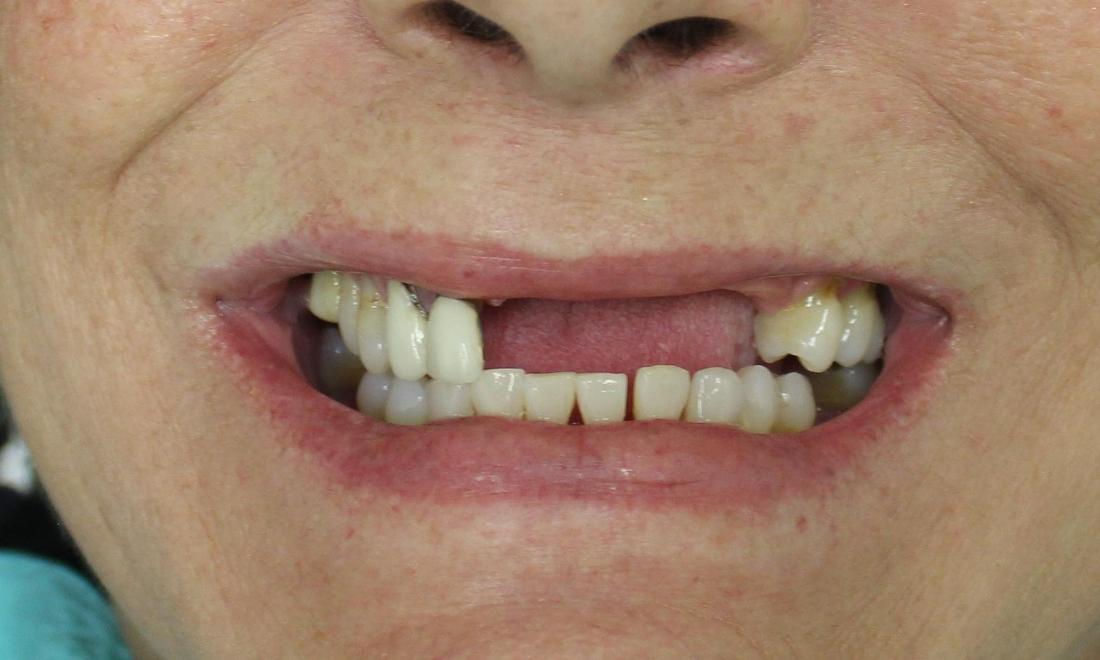 image of patient with missing teeth | temple tx