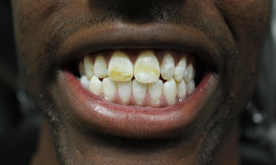 image of discolored & poorly positioned teeth | temple tx