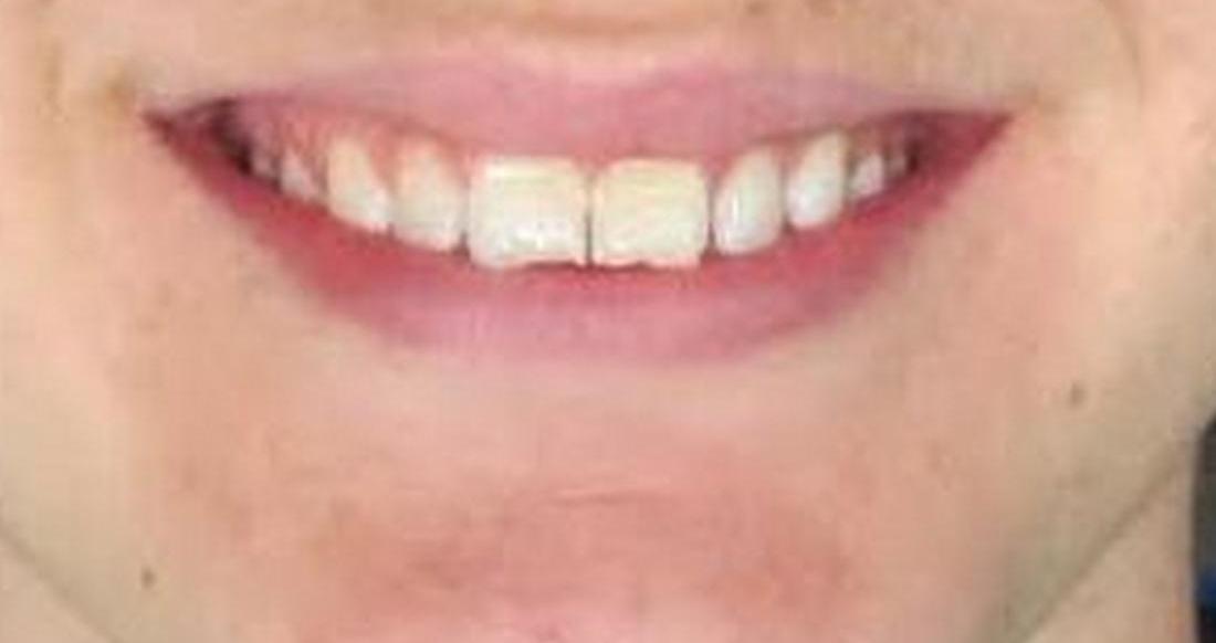 image of worn, chipped, & cracked teeth | temple tx