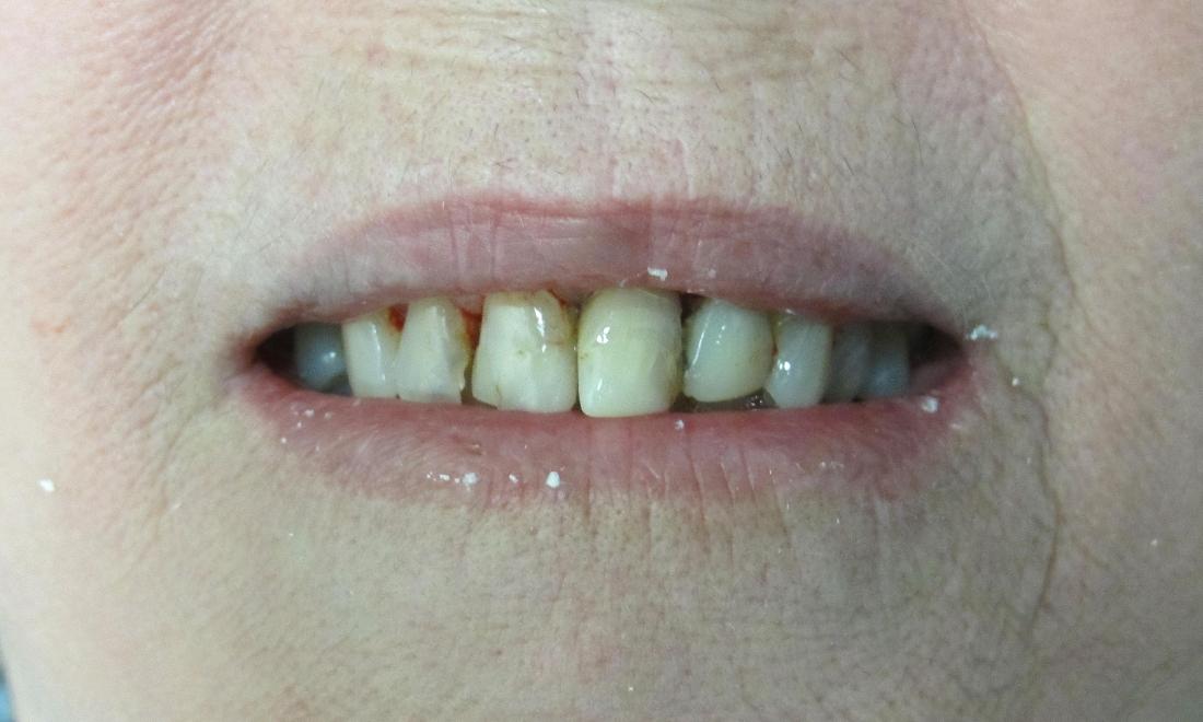 before image of chipped & yellow teeth | temple tx