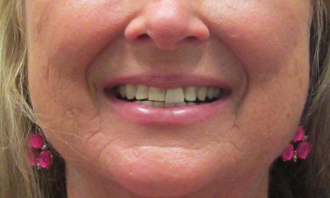 woman before veneers I Temple Dental Trails