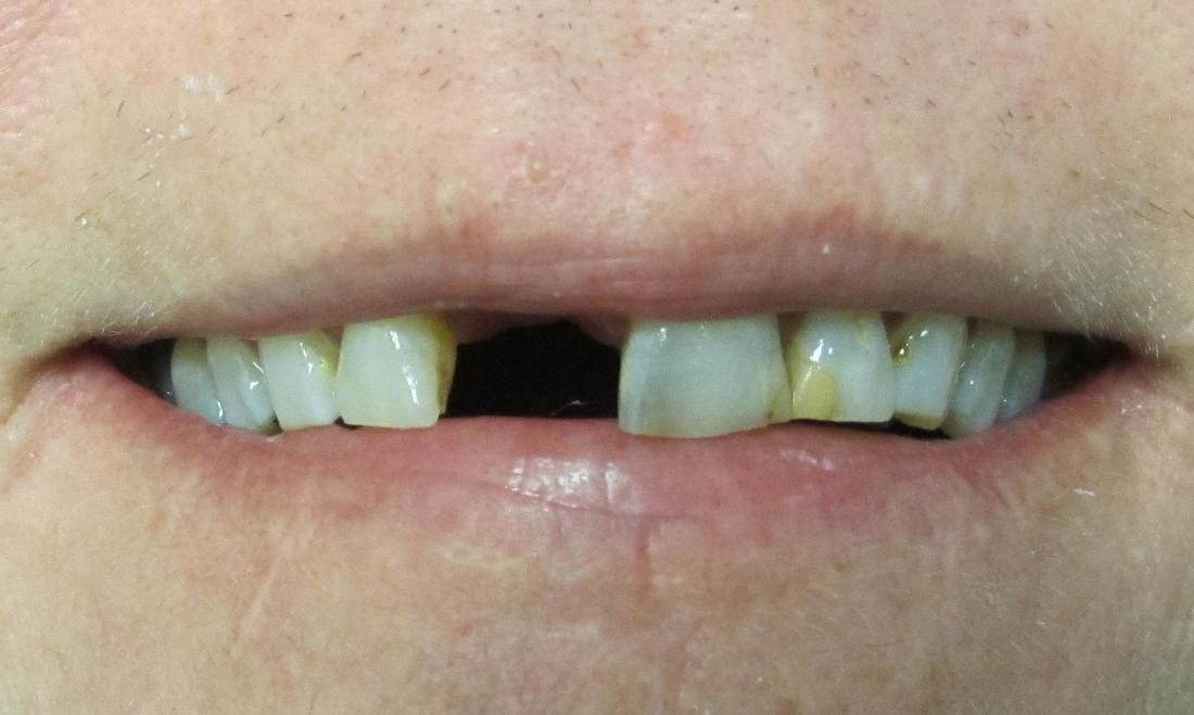 image of discolored and missing teeth | temple tx