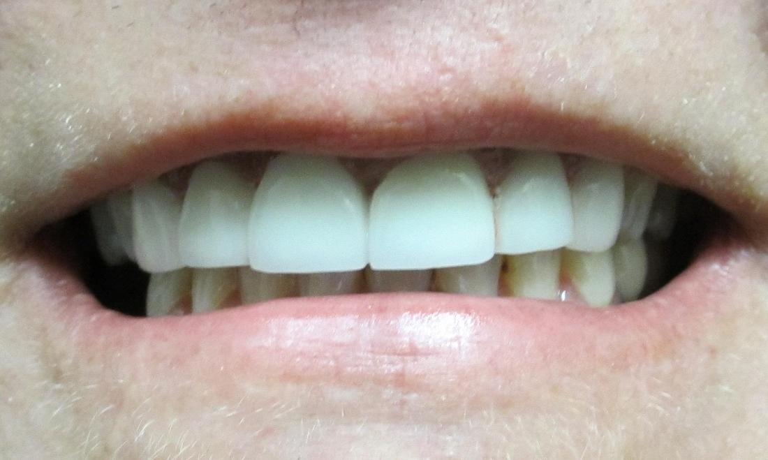 Image of the same teeth after crowns and a fixed bridge | temple tx
