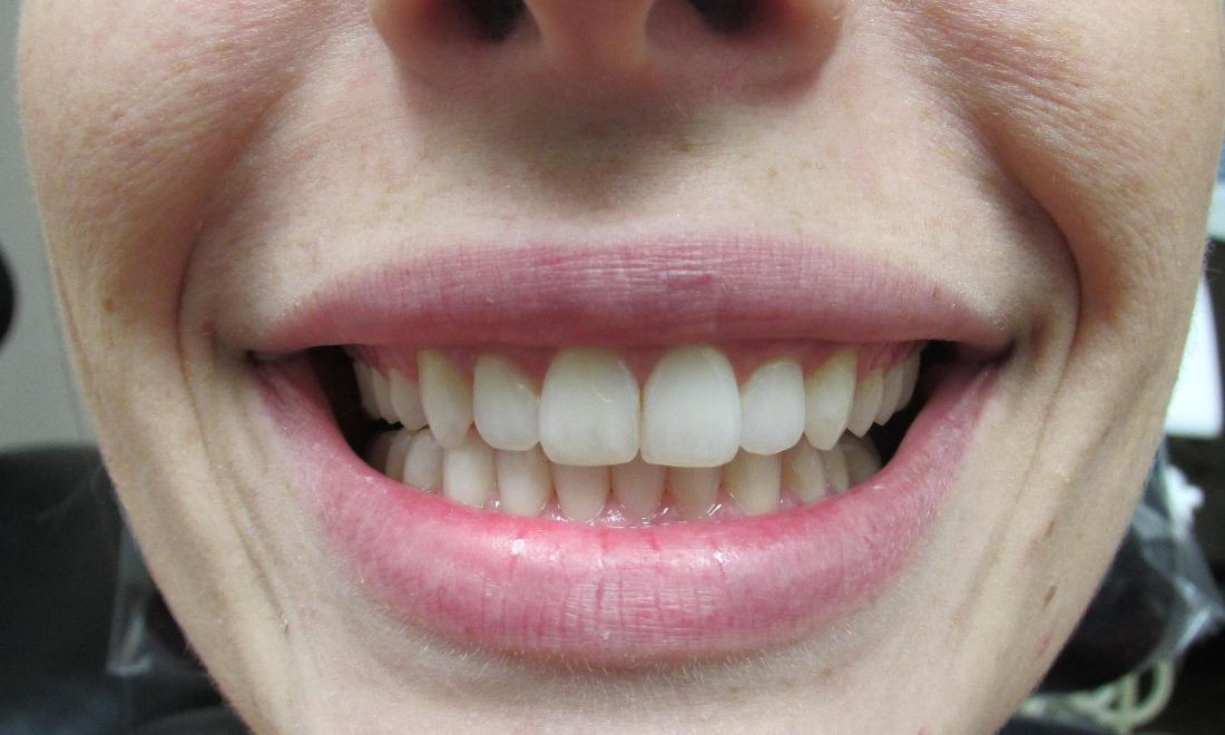 image of the same teeth after invisalign | temple tx