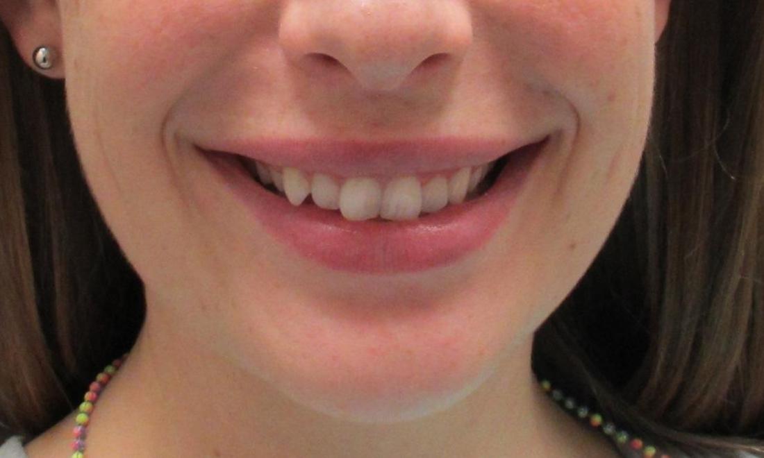 image of teeth before invisalign | temple tx