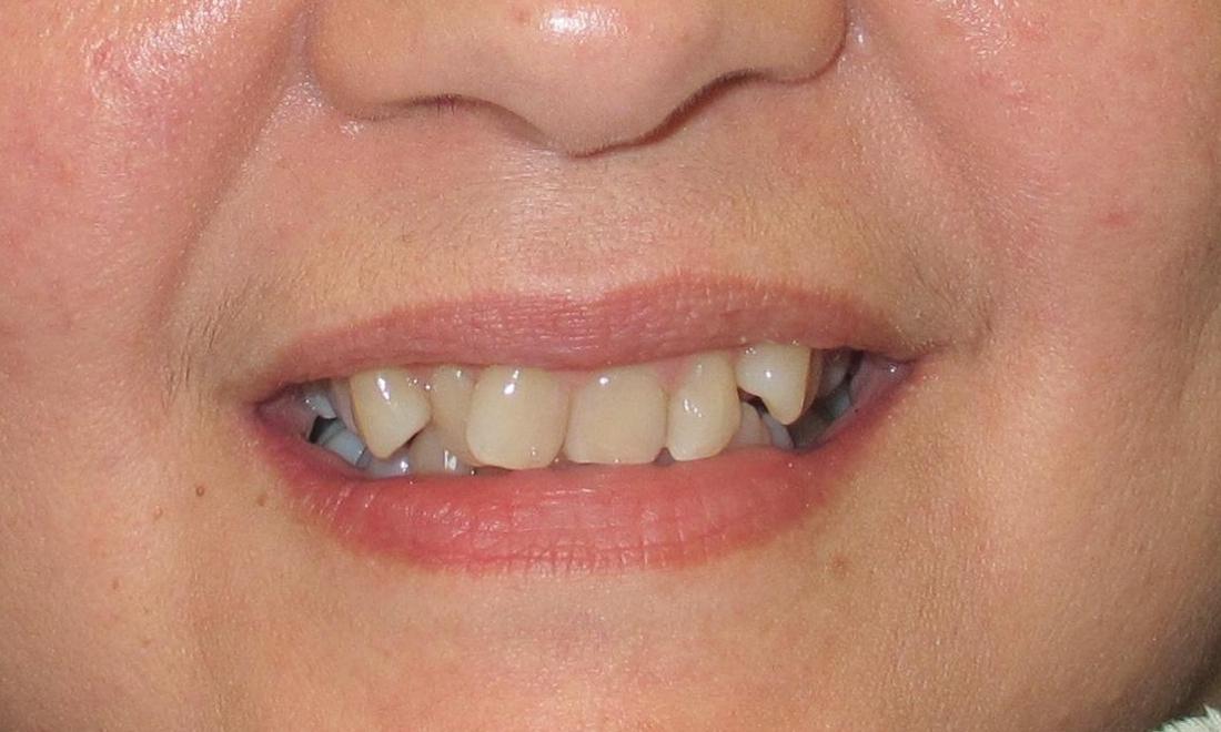 before image of crooked teeth before orthodontics | temple tx
