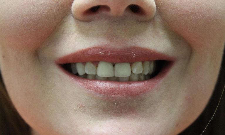 Porcelain-Crowns-After-Image