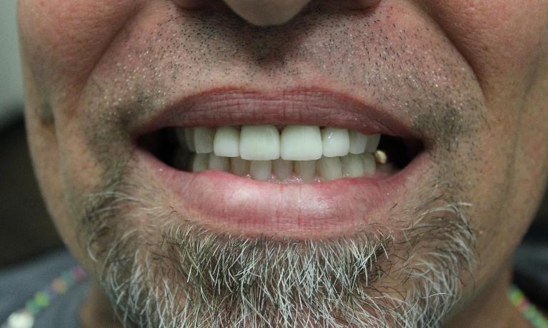 image of the same teeth after zoom whitening & porcelain crowns | temple tx