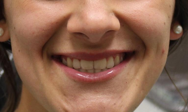 image of the same teeth after orthodontic treatment | temple tx