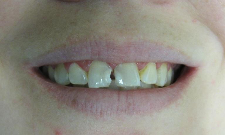 Porcelain-Crowns-Before-Image