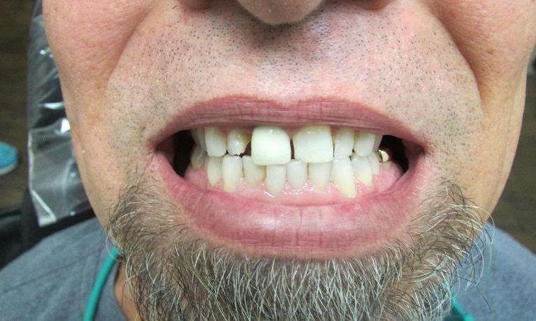 image of discolored and poorly spaced teeth | temple tx