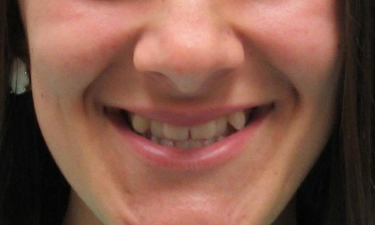 image of teeth before orthodontic treatment | temple tx