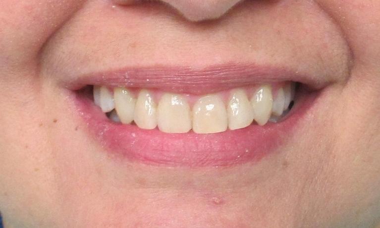 after image of the same teeth after clear braces | temple tx